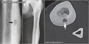 osteoid-osteoma_x-ray_ct