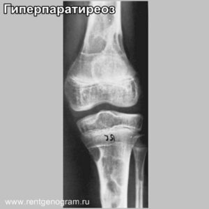 hyperparathyreosis_brawn_tumor_x-ray