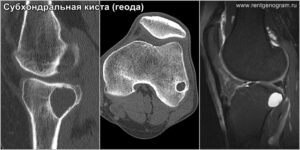 subchondral_cyst_geods_ct_&_mri_pd-fs