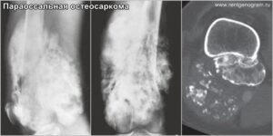 parosteal_osteosarcoma_x-ray_&_ct