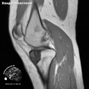 chondroblastoma_knee_mri_t1_se_sag