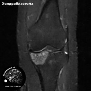 chondroblastoma_knee_mri_t2_fs_cor