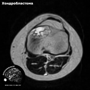 chondroblastoma_knee_mri_t2_tra