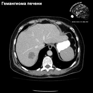hemangioma_liver_ct+gd_tra