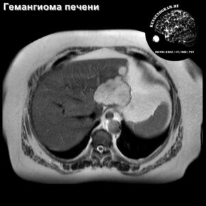 hemangioma_liver_left_lobe_mri_t2_tra