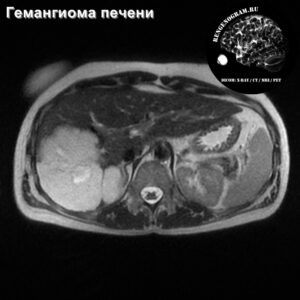 hemangioma_liver_mri_t2_tra