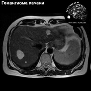 hemangioma_multiple_liver_mri_t2_tra
