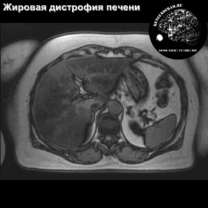 liver_fat_mri_t1_opp_phace_tra