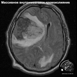 1.1-head_MRI_hemorrage_1