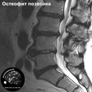 1.1-osteofit_l-spine_MRI_1