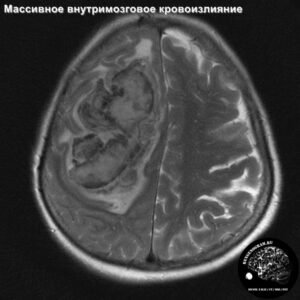 1.2-head_MRI_hemorrage_2