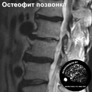 1.2-osteofit_l-spine_MRI_2