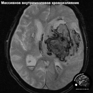 1.3-head_MRI_hemorrage_3