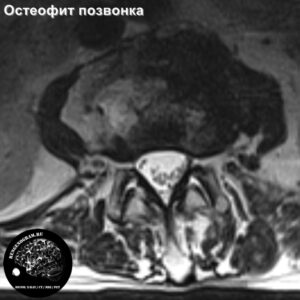 1.3-osteofit_l-spine_MRI_3
