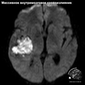 1.4-head_MRI_hemorrage_4