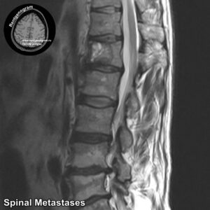1.4-mts_spine_MRI_4