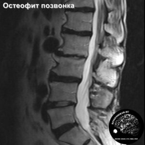 1.4-osteofit_l-spine_MRI_4