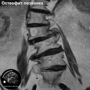 1.5-osteofit_l-spine_MRI_5