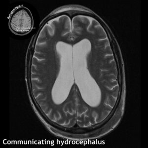 1_Communicating hydrocephalus_MRI_t2_tra