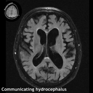 2_Communicating hydrocephalus_MRI_flair_tra