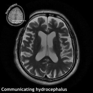 3_Communicating hydrocephalus_MRI_t2_tra
