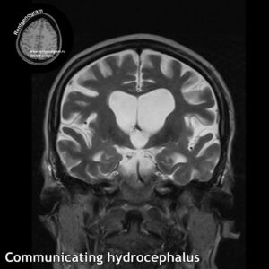 4_Communicating hydrocephalus_MRI_t2_cor