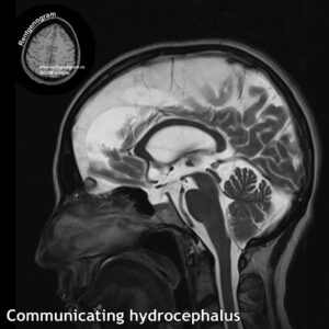 5_Communicating hydrocephalus_MRI_t2_sag