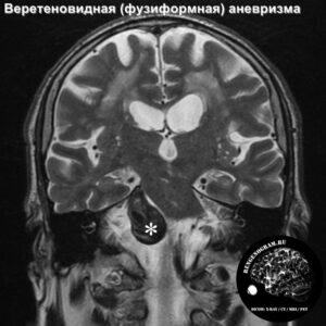 aneurisms_head_MRI_1
