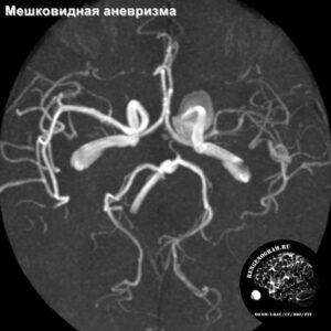 aneurisms_head_MRI_2