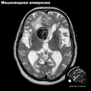 aneurisms_head_MRI_3