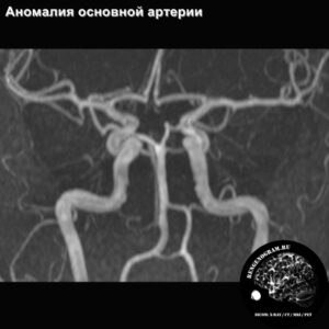 angio_anomaly_MRI_3