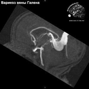 angio_anomaly_MRI_4