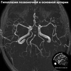 angio_head_MRI_1