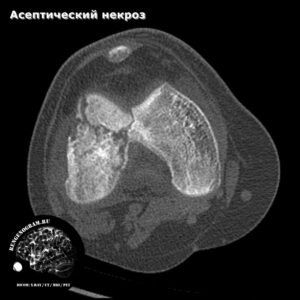 aseptic_necrosis_knee_ct_tra