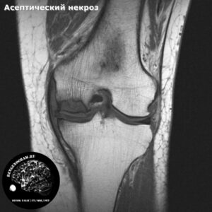 aseptic_necrosis_knee_t1_cor