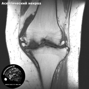 aseptic_necrosis_knee_t1_se_cor