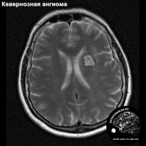 cavernoma_head_MRI_1