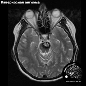 cavernoma_head_MRI_2