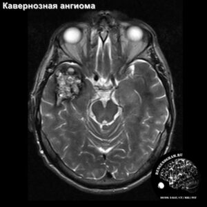 cavernoma_head_MRI_3