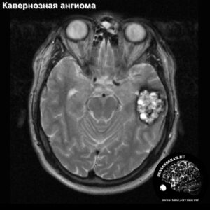 cavernoma_head_MRI_4