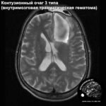 contusio_haed_MRI_1