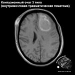 contusio_haed_MRI_4