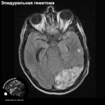 epidural_head_MRI_1
