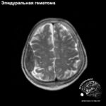 epidural_head_MRI_2