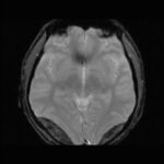 epidural_haed_MRI_3