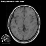 epidural_head_MRI_4