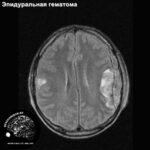 epidural_haed_MRI_5