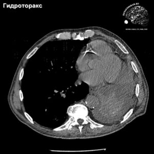 hydrothorax_lung_collaps_ct_tra