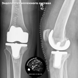 knee_endoprotesis_roentgen