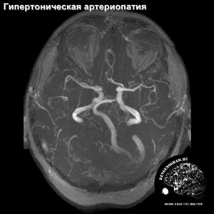 other_angio_head_MRI_1